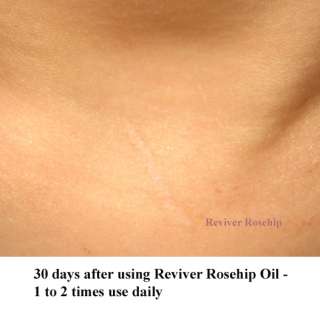 Reviver tm Rosehip Seed Oil penetrates the skin quickly, has 
